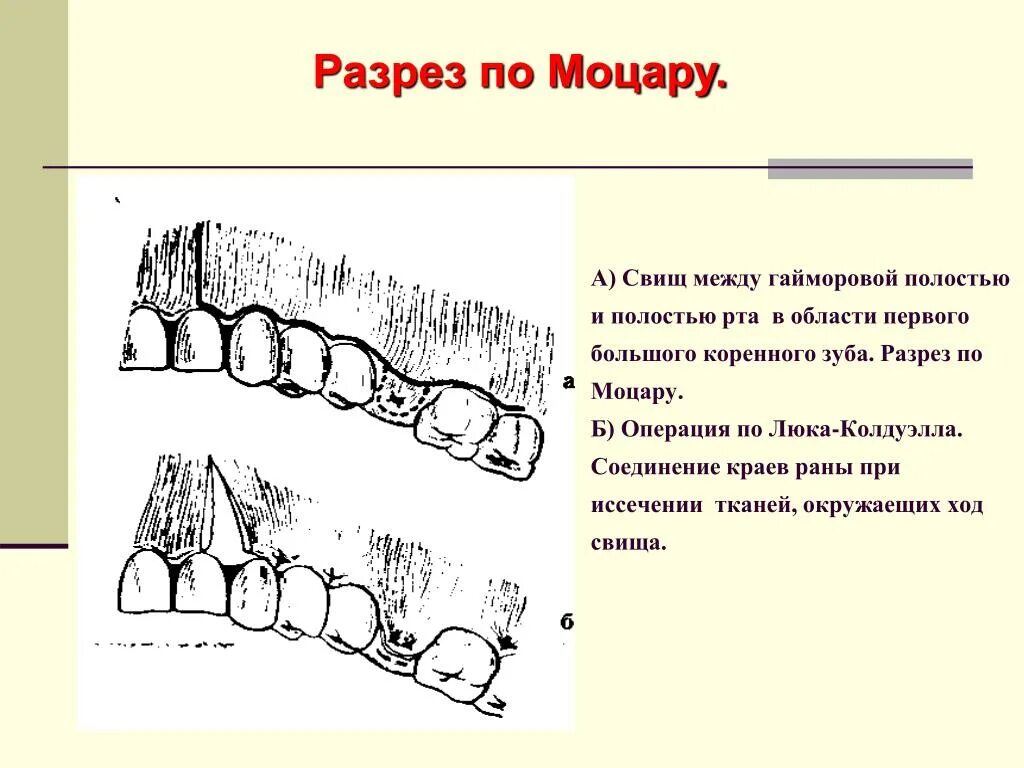Как правильно пишется свищ. Как правильно пишется свищ