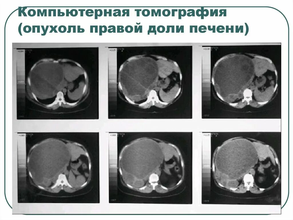 Томография от греч. Имптом «воздушной ловушки». Артериальная фаза контрастирования при кт. Слово на кт начинается. Объемные образования печени кт.
