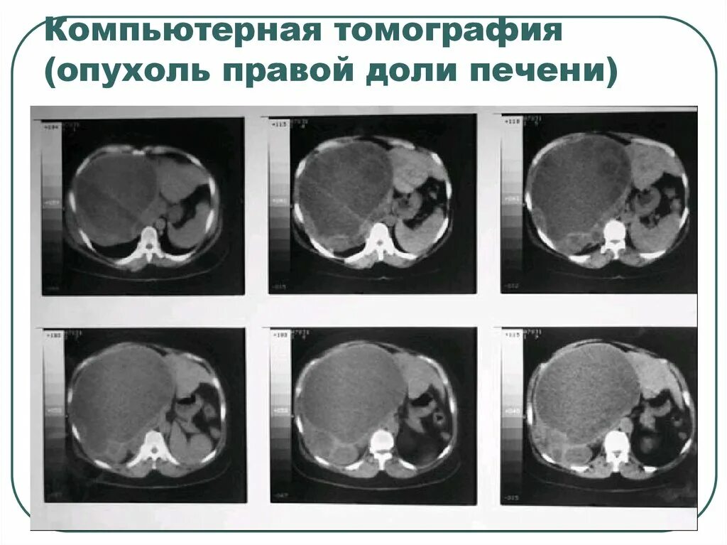 Новообразования в печени на кт. Объемное образование печени на кт. Образования печени кт