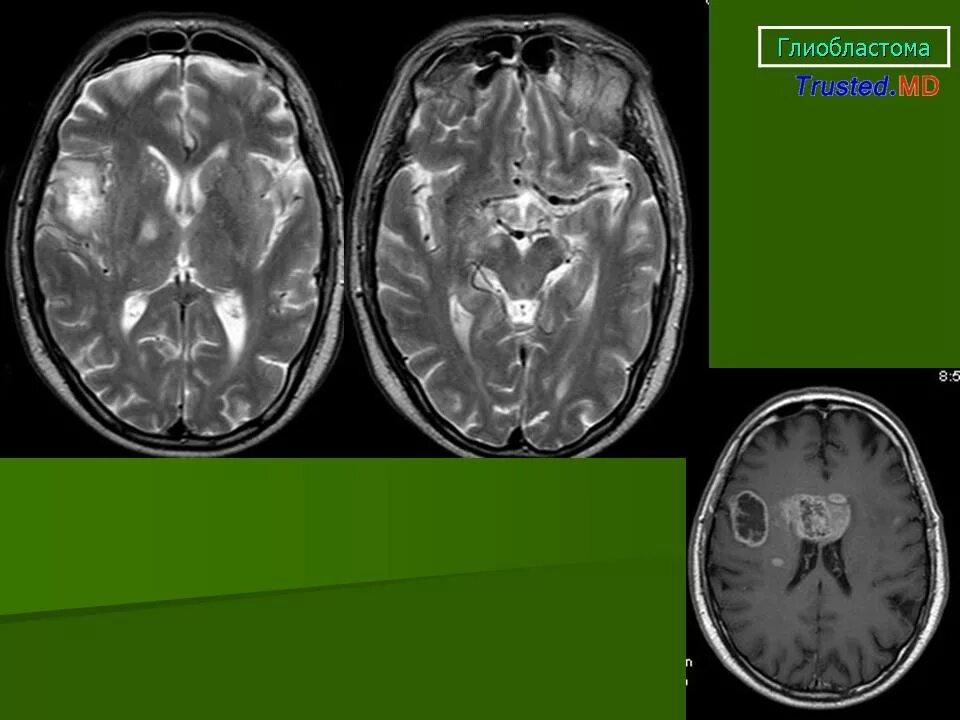 Мультифокальная глиобластома. Глиобластома головного мозга на кт. Мультифокальная глиобластома кт. Симптомы глиобластомы головного