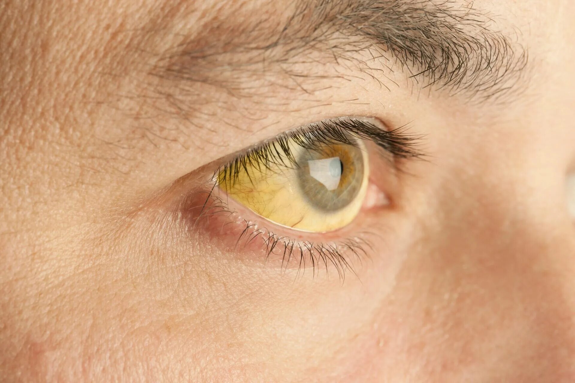 Синдром Жильбера желтые глаза. Синдром Жильбера пожелтение склер. Пожелтение склер гепатит.