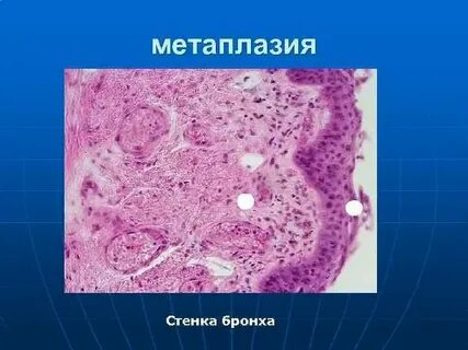 Плоскоклеточная метаплазия матки что это