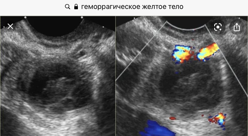 Какая норма кисты. Геморрагическая фолликулярная киста яичника. Перекрут кисты яичника на УЗИ. Дермоидные кисты яичников на УЗИ. Фолликулярные кисты яичников.