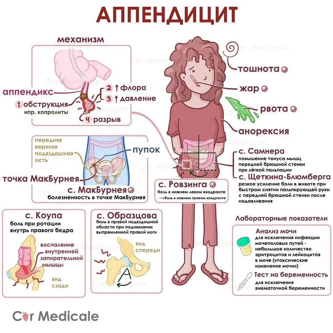 Аппендицит рекомендации. Профилактика аппендицита. профилактика острого аппендицита. памятка при аппендиците.