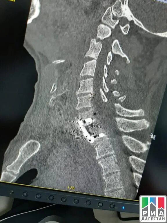 Компрессионный перелом 5 шейного позвонка. Перелом 5 шейного позвонка. Перелом шейного позвонка пациент. Перелом шейных позвонков пациент.