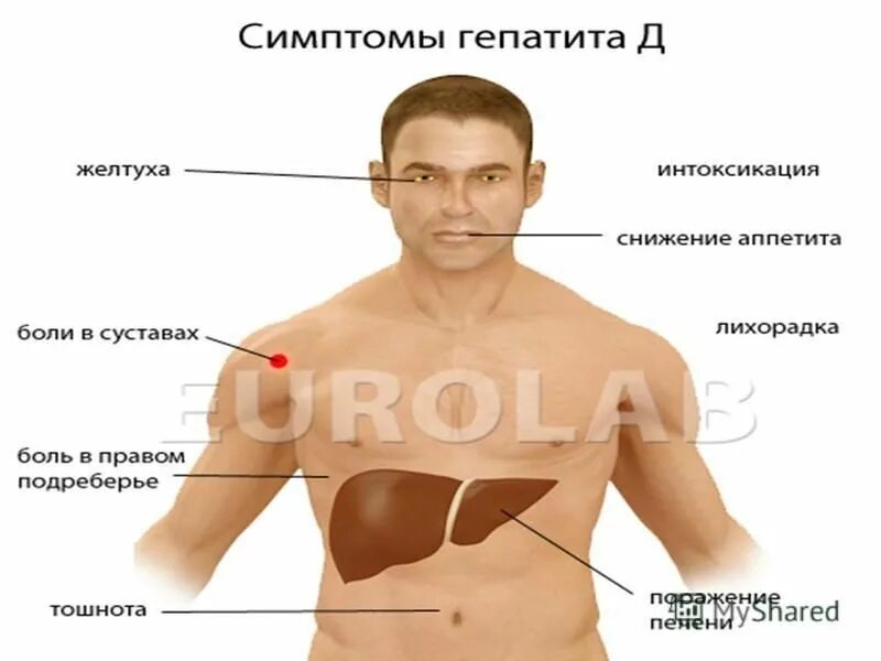 Лицо больного печени. Внешние проявления гепатита с.