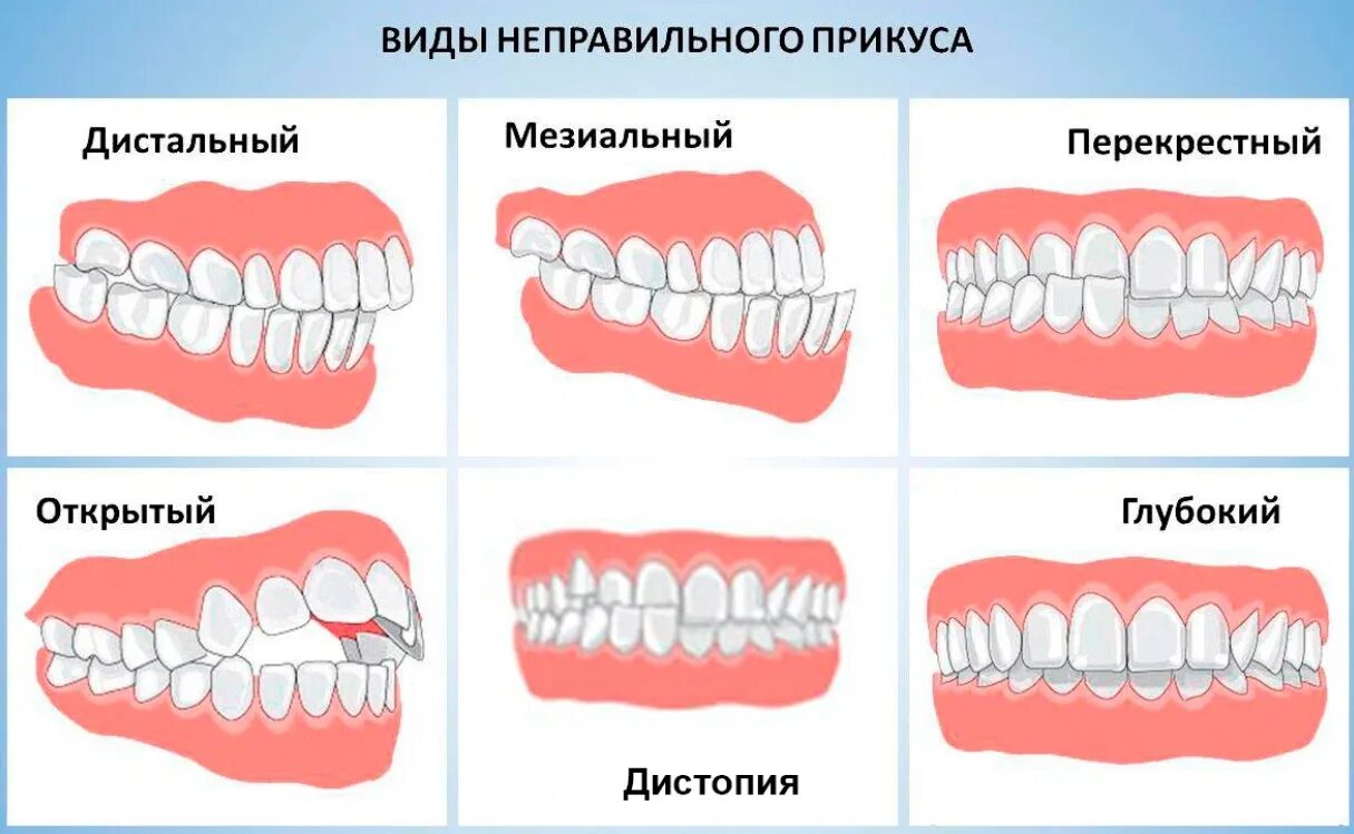 Почему зубы отличаются между собой. Правильный прикус вид сбоку. Правильный прикус зубов сбоку. Правильный прикус у человека схема сбоку. Прикус ортогнатический зубов.