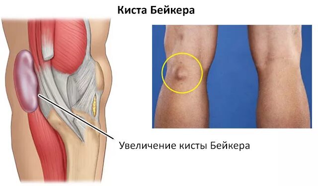Болят суставы коленей причины. Болит колено опухает чем лечить. Болезнь гоффа коленного сустава. Боль в колене с внешней стороны. Припухлость под коленной чашечкой.