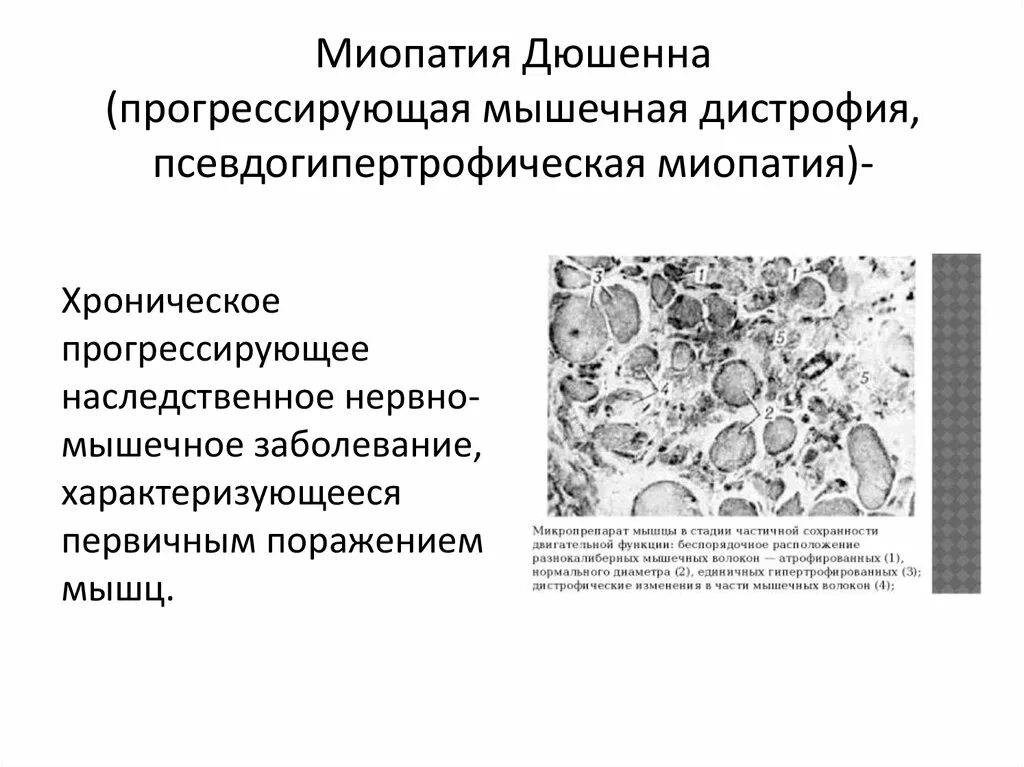 Миопатия что это за болезнь. Патогенез миодистрофии Дюшенна. Миопатия Дюшенна этиология и патогенез.