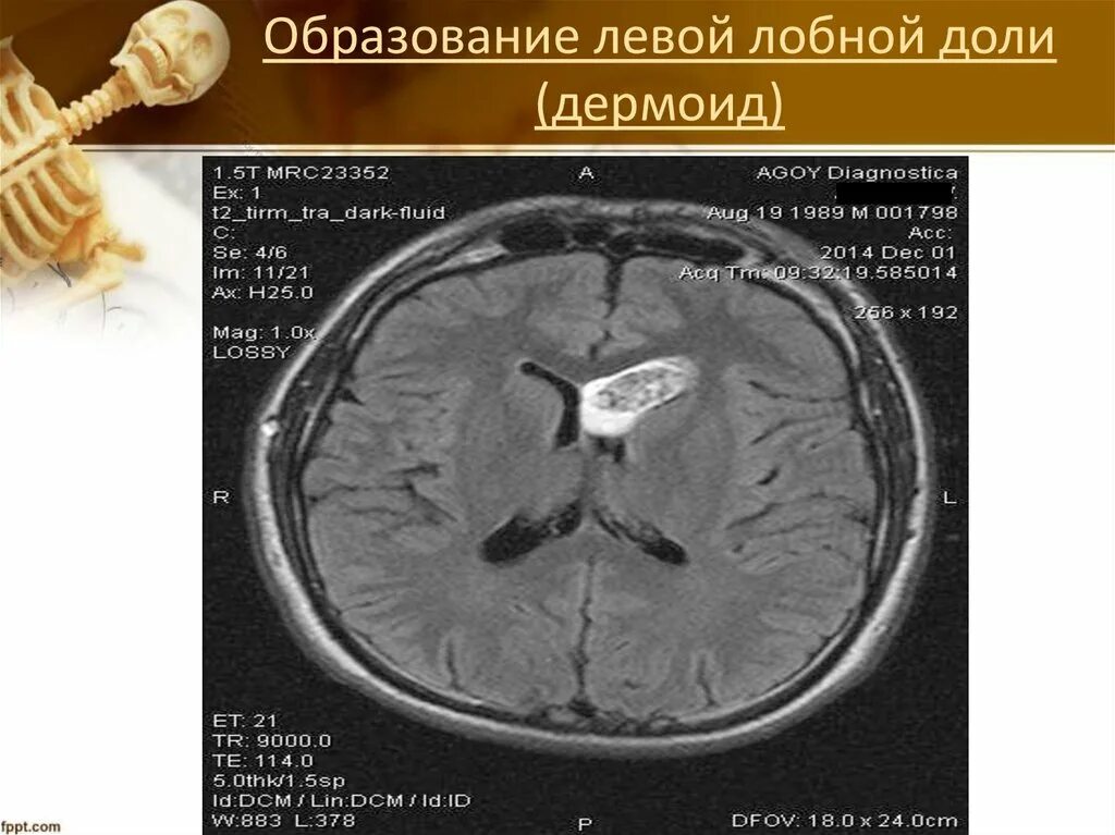 Образование в лобной доле. Мальформация в левой лобной доли. Ангиома левой лобной доли. Венозная мальформация левой лобной доли головного мозга.