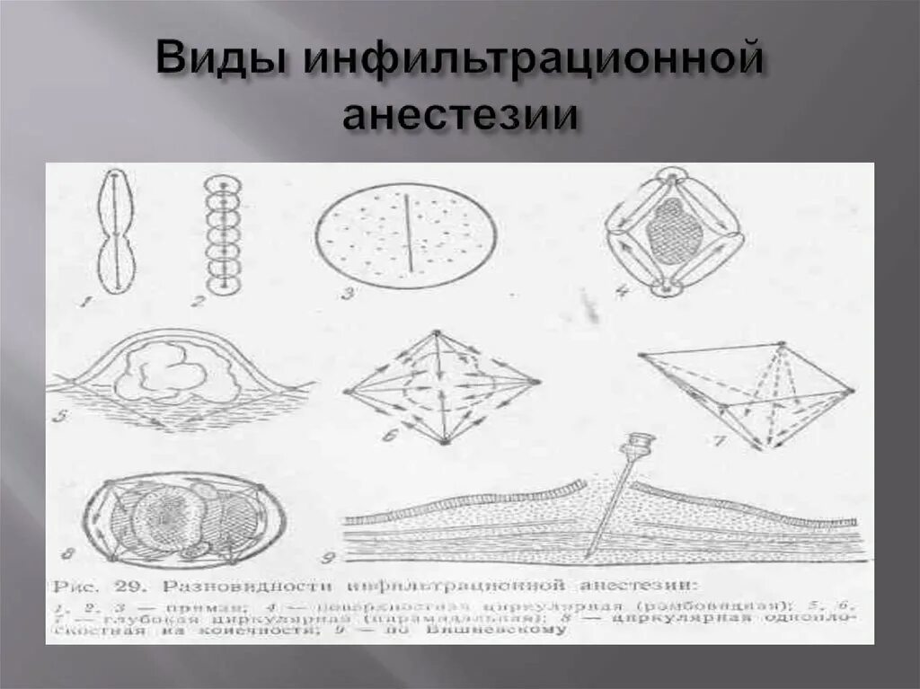 Виды инфильтрационной анестезии. Разновидности инфильтрационной анестезии. разновидности инфильтрационной анестезии ветеринария. разновидность местной инфильтрационной анестезии. инфильтрационная анестезия анестетик фарма.
