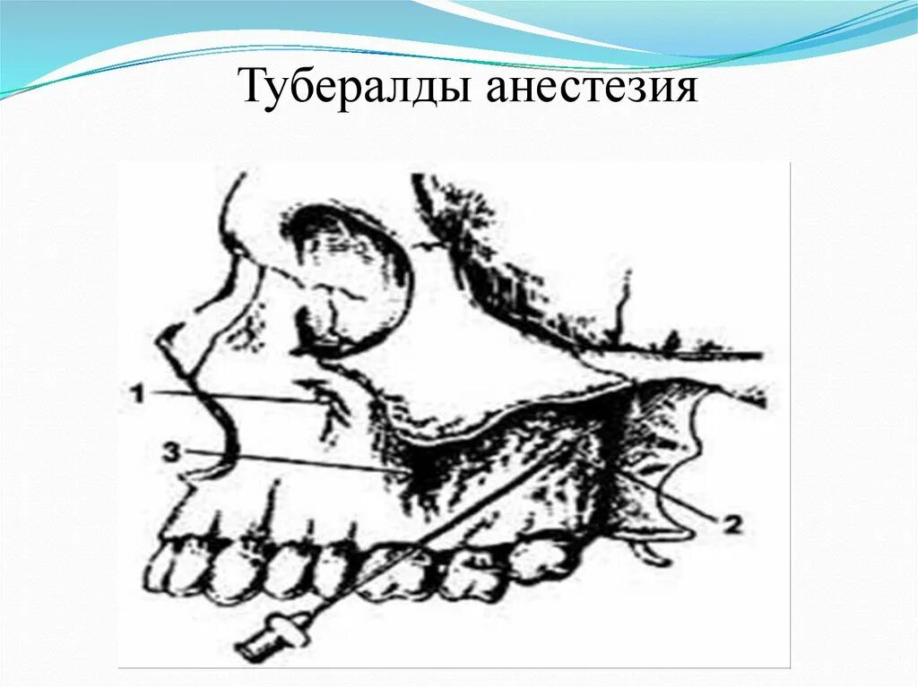 Подглазничная анестезия. Туберальная анестезия верхней челюсти. резцовая проводниковая анестезия. туберальная анестезия нерв. проводниковая анестезия резцовая небная.