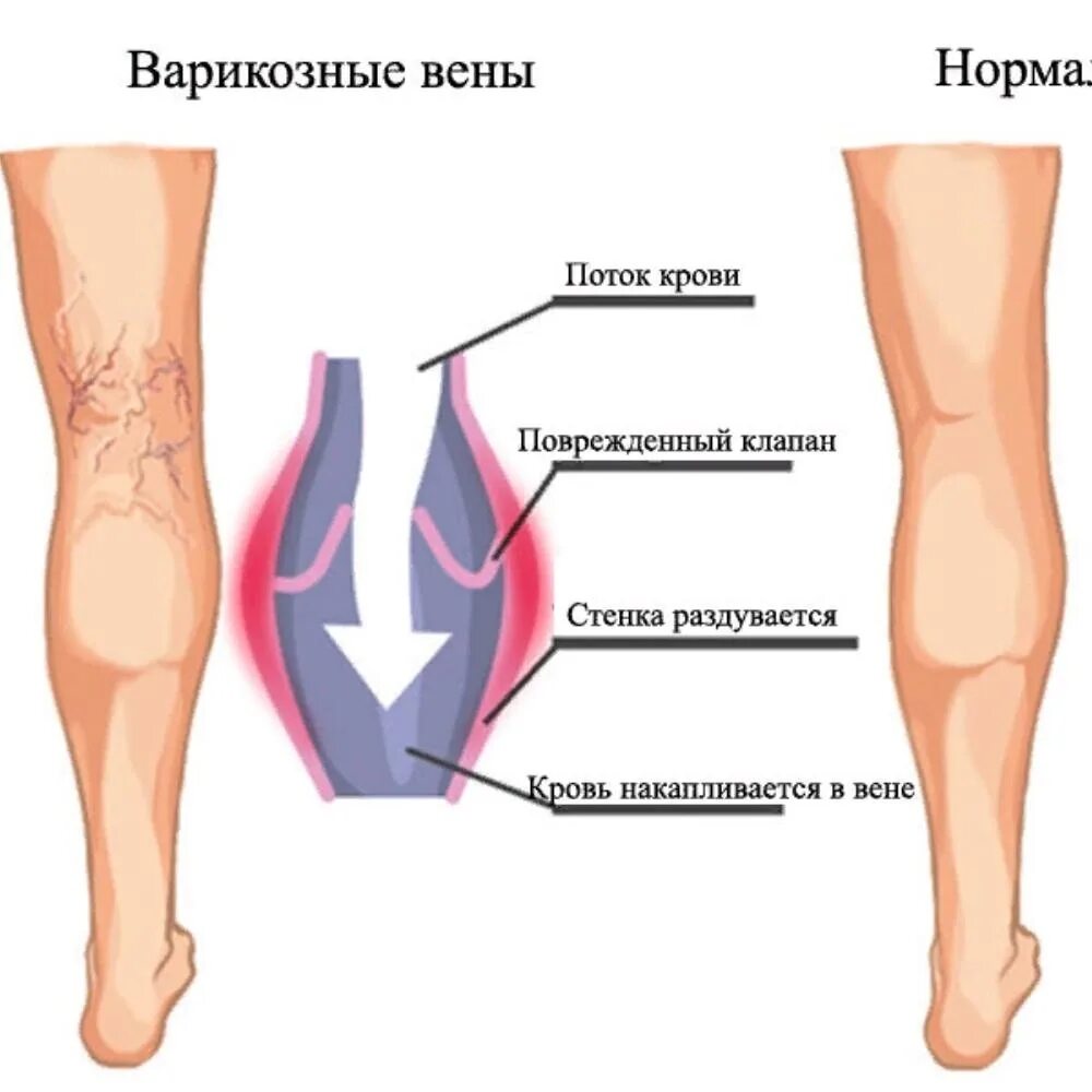 Варикозное расширение вен нижних конечностей формы. Варикозная болезнь вен нижних конечностей стадии. Варикозное заболевания расширение вен нижних конечностей. Варикозное расширение вен (ВРВ) нижних конечностей. Классификация. Причины расширенных вен