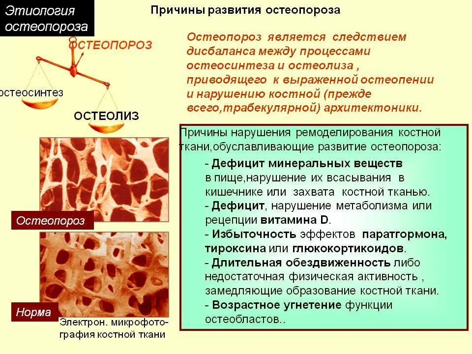 Структура костной ткани остеопороз. Структура костной ткани порозна что это. Остеопороз этиология. Основная причина развития остеопороза.