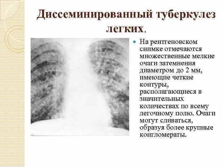 Диссеминированный туберкулез фаза инфильтрации. Подострый диссеминированный туберкулез рентген. Милиарный диссеминированный туберкулез рентген. Хронический диссеминированный туберкулез рентген. Диссеминированный туберкулез легких снимки рентген.