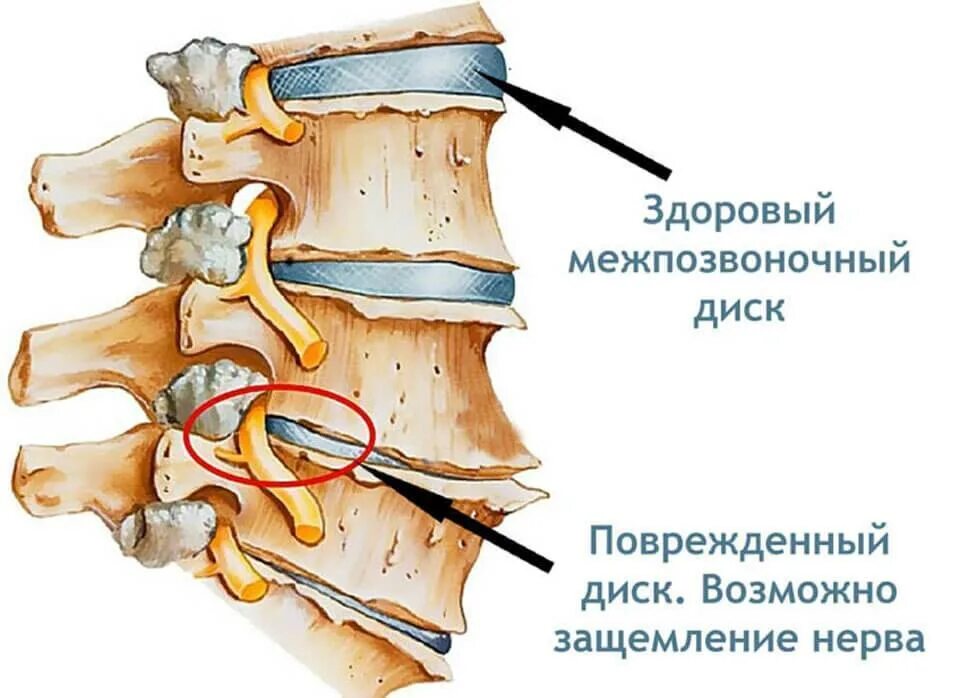 Защемило правую сторону шеи что делать. Повреждение межпозвоночных дисков поясничного отдела. Защемление позвонка l5-s1. Защемление нервных Корешков. Межпозвонковые диски поясничного отдела позвоночника.