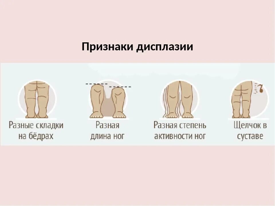 Степени дисплазии тазобедренных суставов. Дисплазия тазобедренного сустава факторы. Степени дисплазии тазобедренных. Дисплазия тбс схема. Норма предвывих,подвывих,вывих тазобедренного сустава.