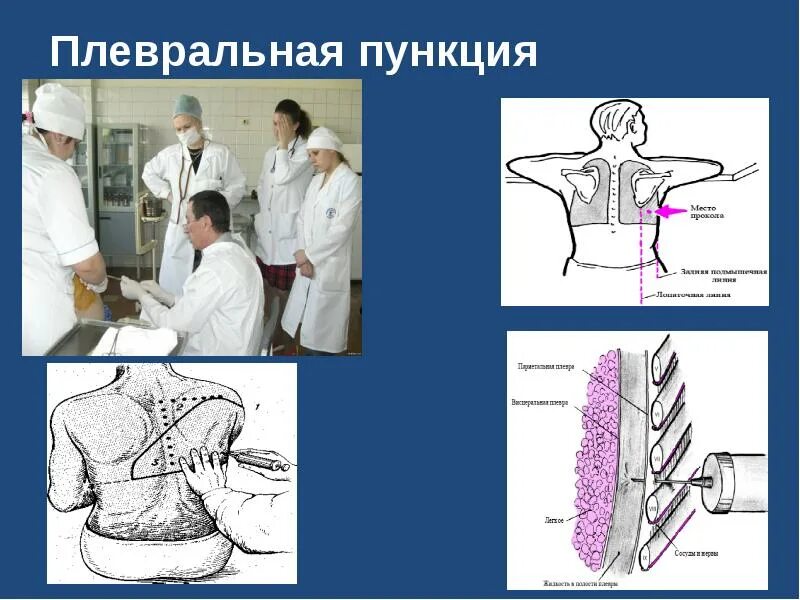 Техника выполнения плевральной пункции. Плевральная пункция (торакоцентез). Плевральная пункция топографическая анатомия. Плевральная пункция алгоритм. Алгоритм взятия плевральной пункции.