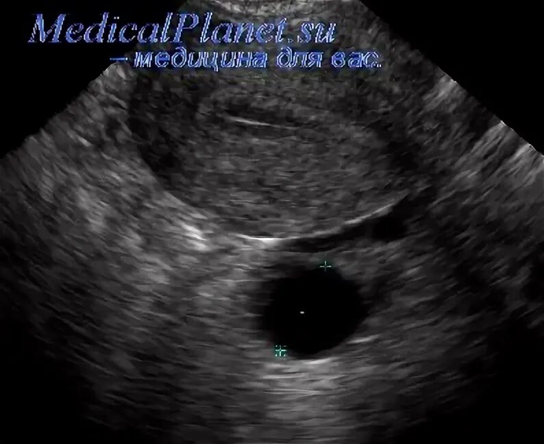 Плод в полости матки. Темное пятно на УЗИ матки. Чёрное пятнышко на УЗИ матки. Черная точка в матке на УЗИ.