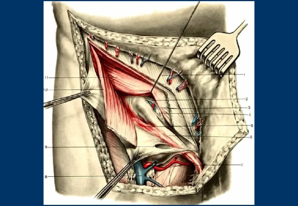 Брюшная стенка после операции. Мышцы пахового канала анатомия. Хирургическая анатомия бедренных грыж. Мышцы живота и паховый канал анатомия. Передняя брюшная стенка топографическая анатомия грыжи.