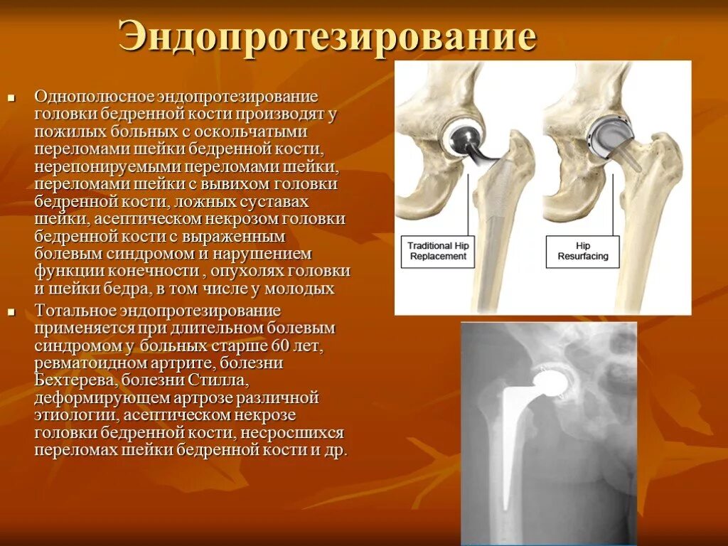 Операция тазобедренный кость