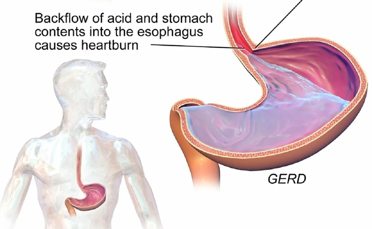 Часто изжога причины у мужчины. Пищеводная и желудочная рвота. Желудочный сок в пищеводе.
