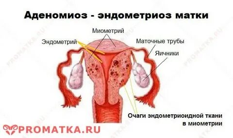 Эндометриоз после месячных