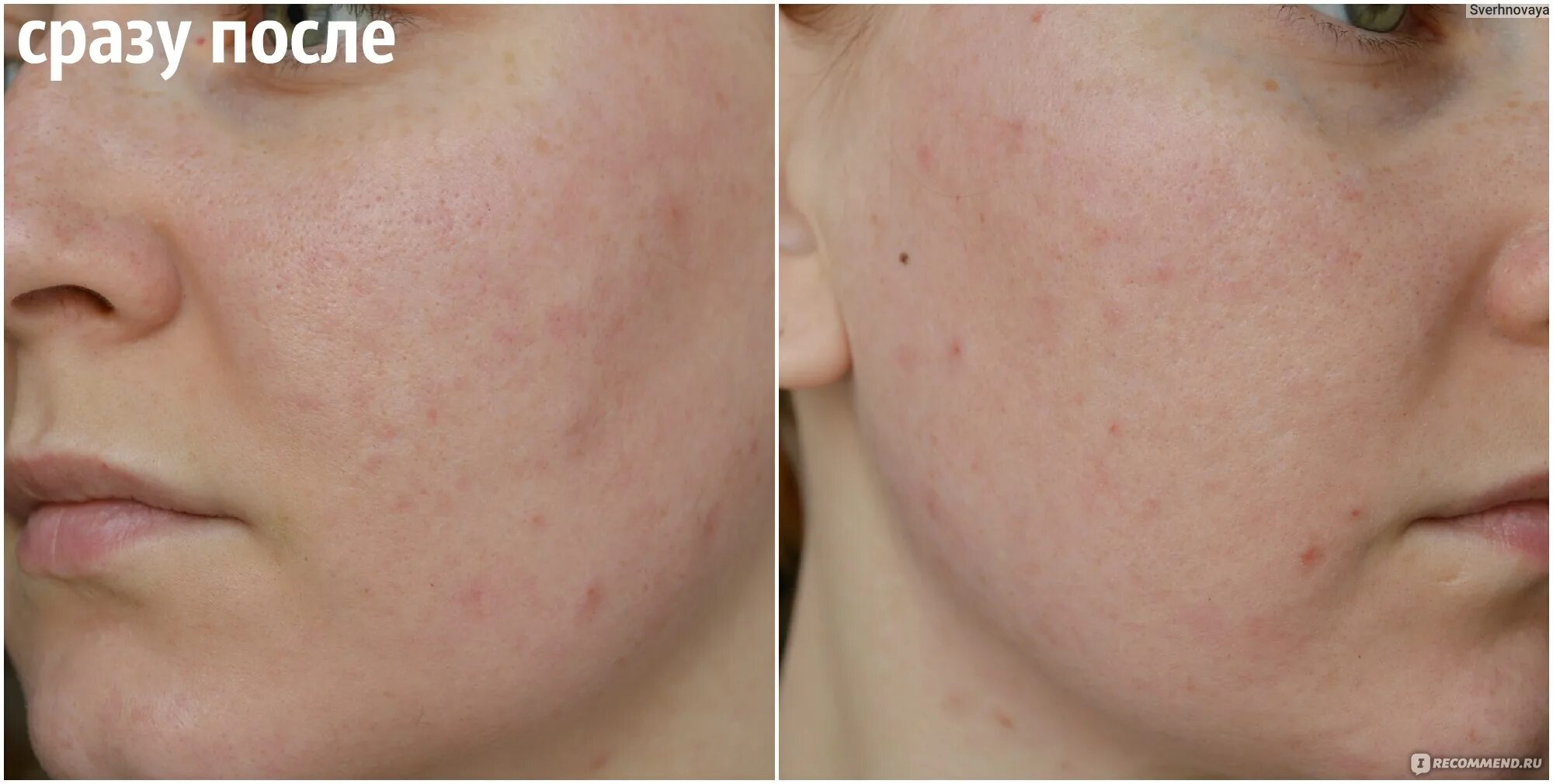 Пилинг роз. Пилинг роз. Пилинг роз. Пилинг роз. Пилинг роз.