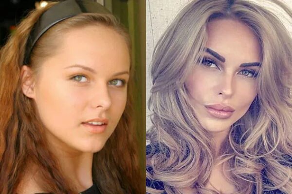 Ханна до операции и после фото пластические До и после ПЛАСТИКИ. ХАННА Жизнь знаменитостей и не только Дзен