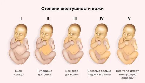 Желтушка у новорожденных при грудном вскармливании