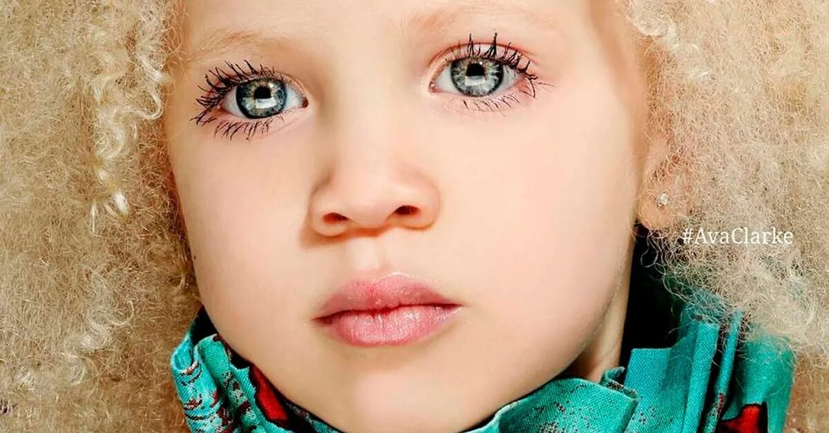 Необычный цвет глаз. Темнокожие с рыжими волосами. Красивые глаза. Темнокожие с рыжими волосами. Самая редкая девочка в мире.