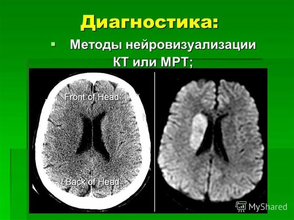 Субатрофические изменения мозга. Кт и мрт Нейровизуализация. Ишемический инсульт кт. Нейровизуализация ишемического инсульта. Нейровизуализация отека мозга.