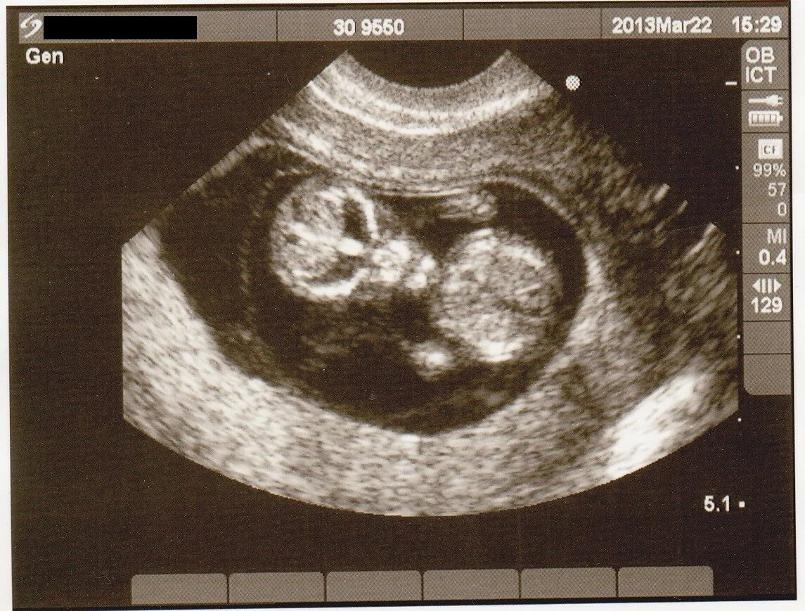 Ребенок 11 недель узи. УЗИ 11 недель беременности. Страшные снимки УЗИ беременных.