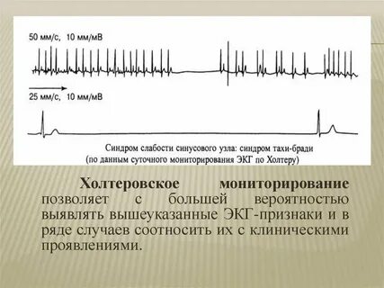 Синусовый узел экг