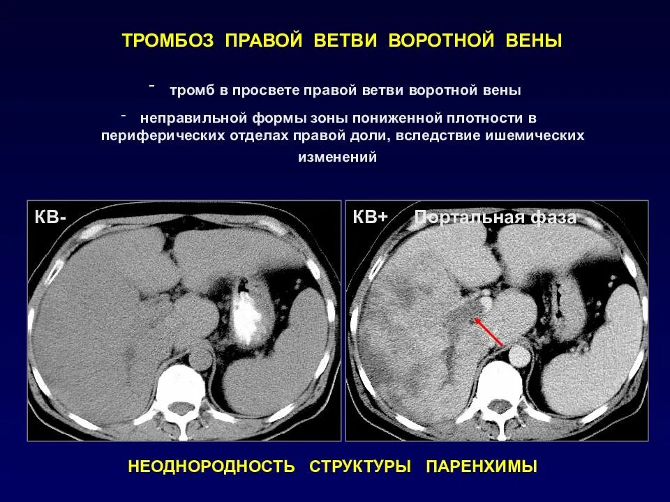 Тромб в печени