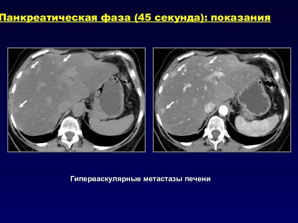 Образования печени кт. Гиперваскулярные образования печени на кт. гиповаскулярные метастазы печени кт. гиперваскулярный метастаз печени на кт. гиповаскулярные метастазы печени мрт.