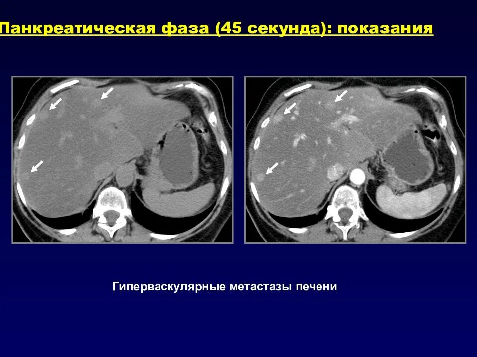 Гиперваскулярные образования печени на кт. Гиповаскулярные метастазы печени кт. Гиперваскулярный метастаз печени на кт. Гиповаскулярные метастазы печени мрт. Образования печени кт