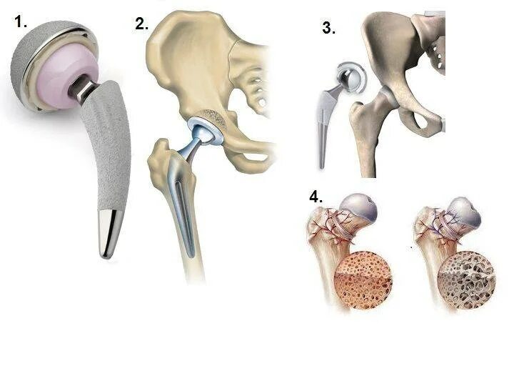 Как происходит операция по замене тазобедренного сустава. Ревизионное эндопротезирование тазобедренного сустава. Эндопротез тазобедренный Stryker v40tm. Sanatmetal эндопротез тазобедренного сустава. Smith nephew эндопротез тазобедренного сустава.