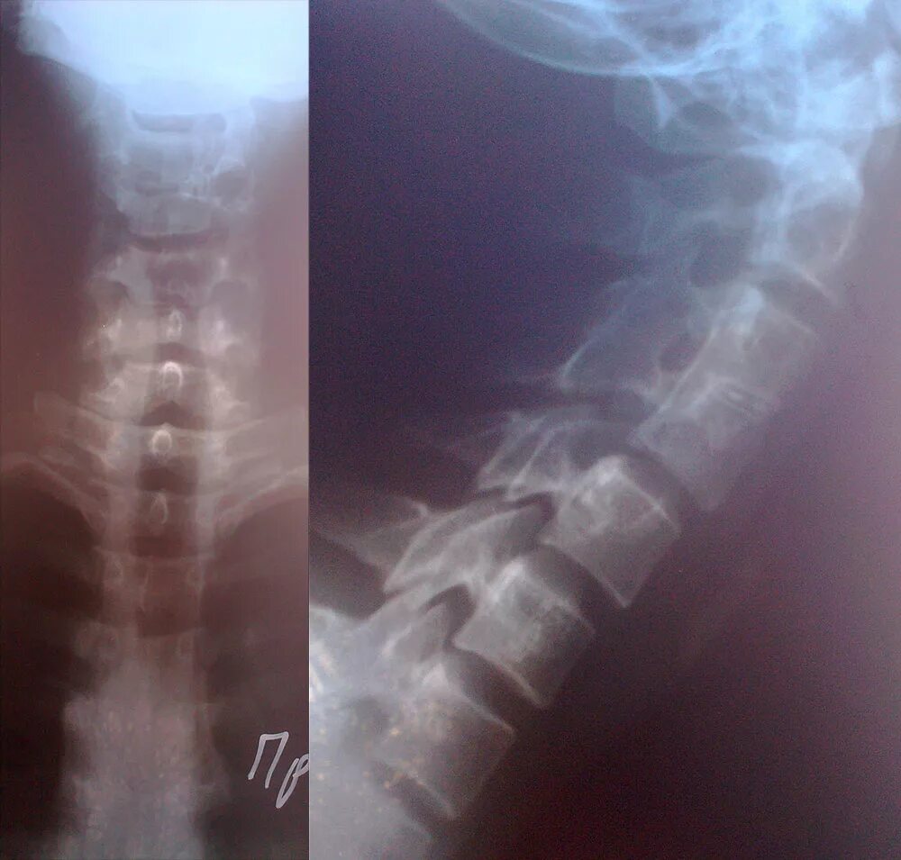 Аномалии развития позвоночника. Кифоз с4-5. С4-с5 кифоз шейного отдела. Кифоз шейного отдела рентген. Конкресценция позвонков с4-с5.