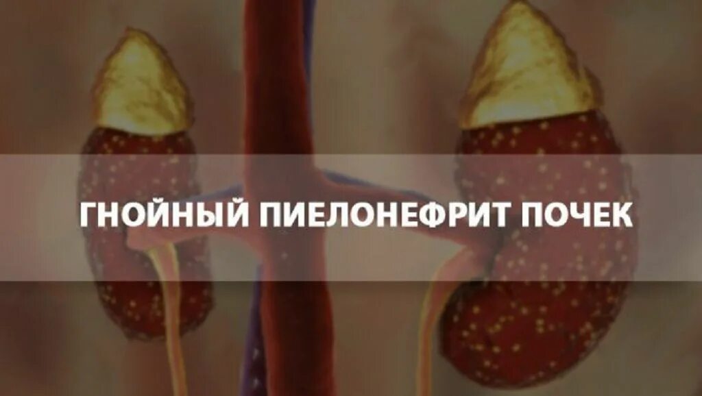 Острый гнойный пиелонефрит. Гнойный пиелонефрит почек. Гнойно воспалительные заболевания почек.