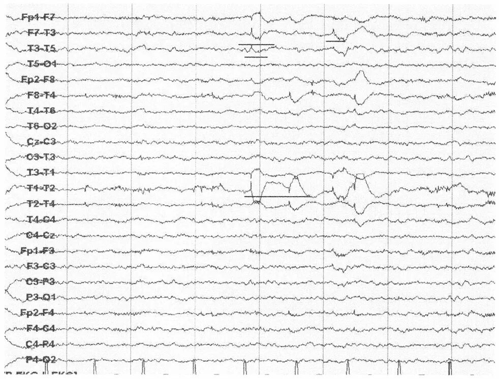 Спайк на ээг. ЭЭГ сигнал. ЭЭГ компакт Нейро. Альфа ритм ЭЭГ. Окулограмма на ЭЭГ что это.