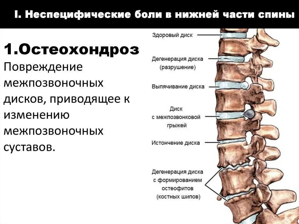 Что значит боли в пояснице. Остеохондроз спины. Болит спина в нижней части позвоночника. Позвоночник больного остеохондрозом.