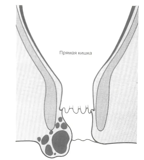 Трещины прохода. Перианальный геморроидальный тромбоз. Тромбоэмболия геморроидального узла. Тромбированный узел геморрой.