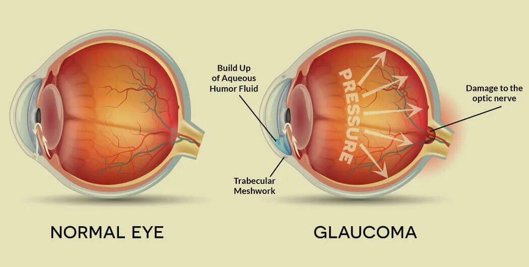 Патологии зрительного нерва глаукома. Здоровые глаза.