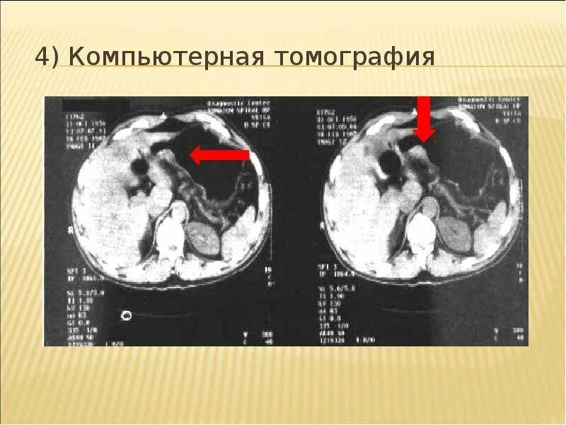 Рак желудка 4 стадии фото Рак пищевода и желудка презентация