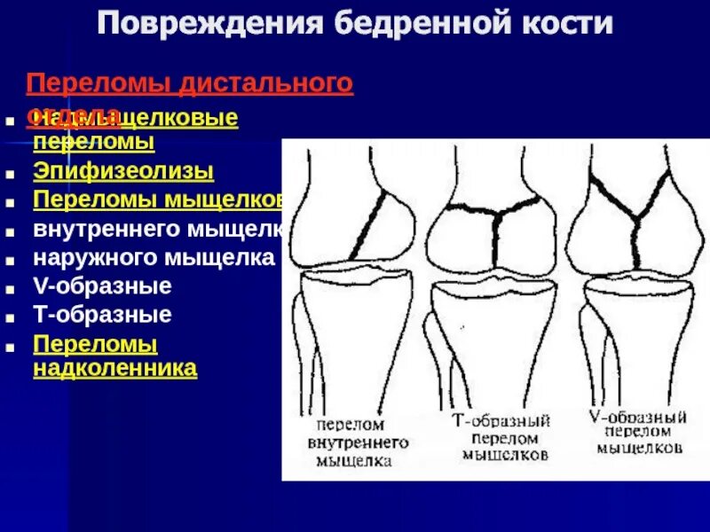 Повреждение мыщелка. Краевой перелом мыщелка бедренной кости. Латерального мыщелка бедренной кости. Вдавленный перелом латерального мыщелка бедренной кости. Перелом мыщелка тазобедренного сустава.