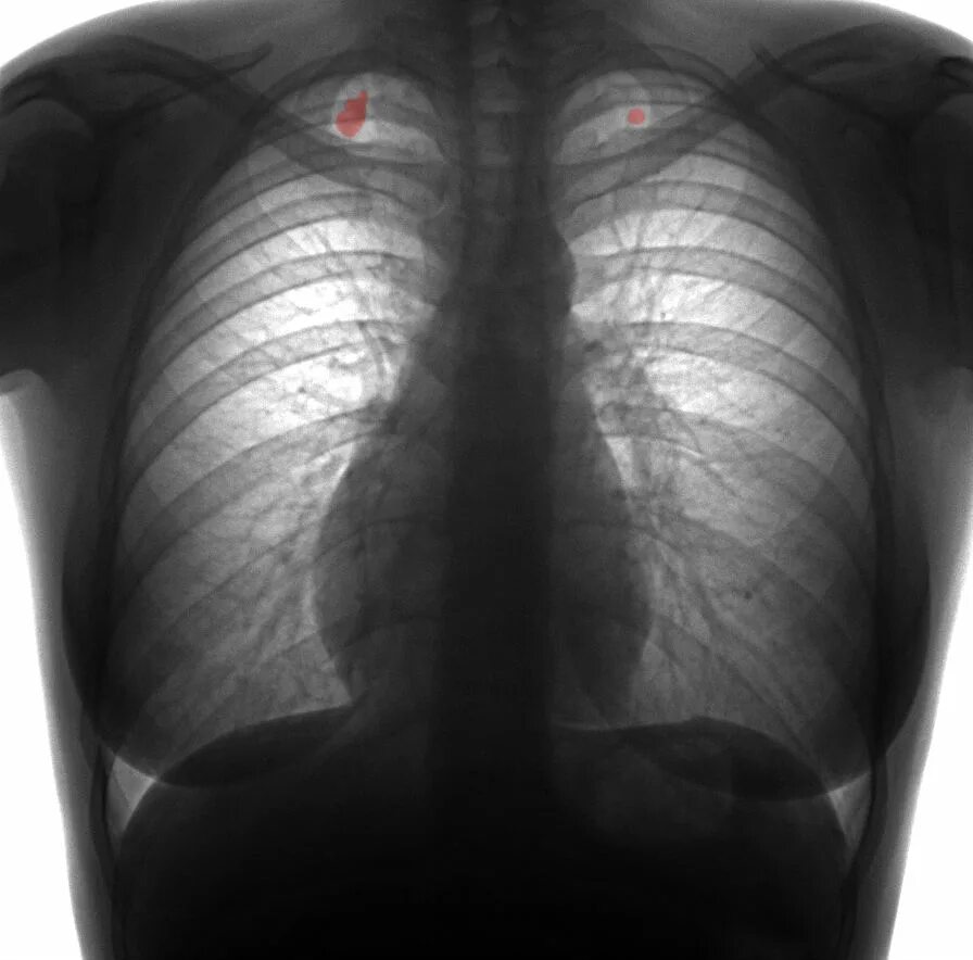 Затемнение на рентгене легких. Затемнение на флюорографии. Затемнения в легких на флюорографии. Флюорография потемнение в легких.