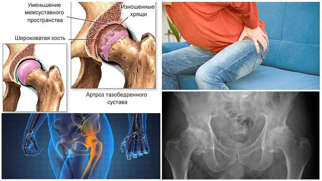 Коксартроз тазобедренного 1 степени у женщин лечение. Посттравматический крузартроз. Коксартроз 3 степени коксартроз тазобедренного сустава. Коксартроз тазобедренного сустава 2. Коксалгия тазобедренного сустава.