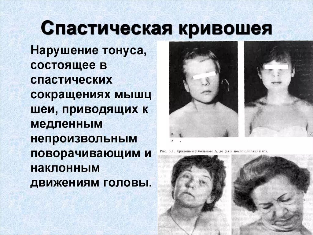 Спастическая кривошея дистония. Гипертонус щечной мышцы. Экстензоры шейного отдела позвоночника. Спастическая кривошея тортиколлис. Спастическая кривошея тортиколлис.