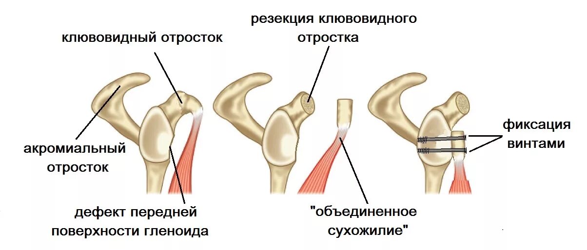 Синдром сдавления ротатора плеча